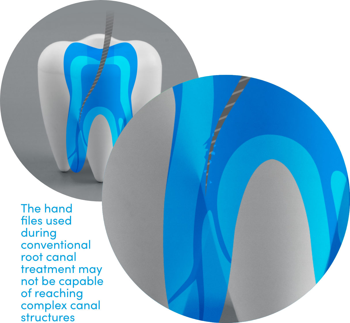 Choosing a Dentist or an Endodontist Root Canal Treatment